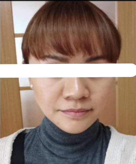 小顔美肌サロンM Subject A — After